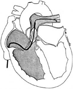 تنگی دریچه ریوی